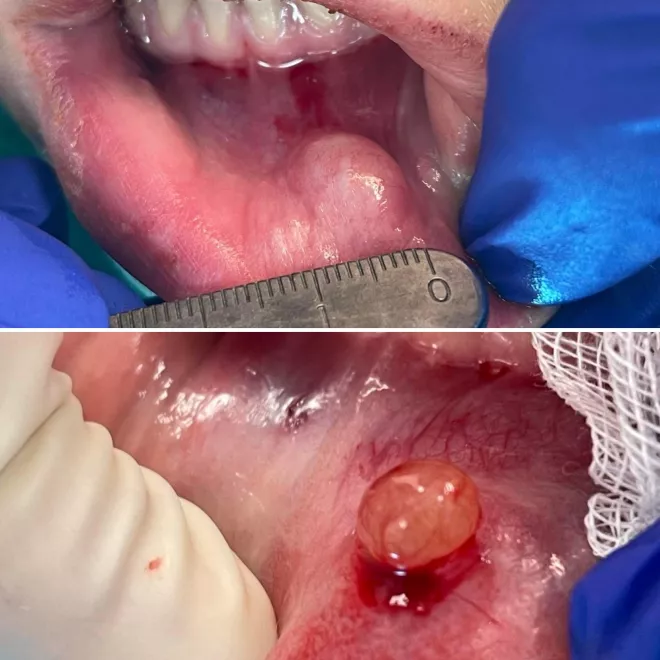 traitement chirurgical d'un mucocèle pour le chirurgien bucco-dentaire à Gembloux.