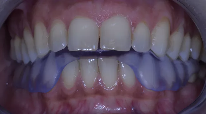 Quand consulter un occlusodontiste?