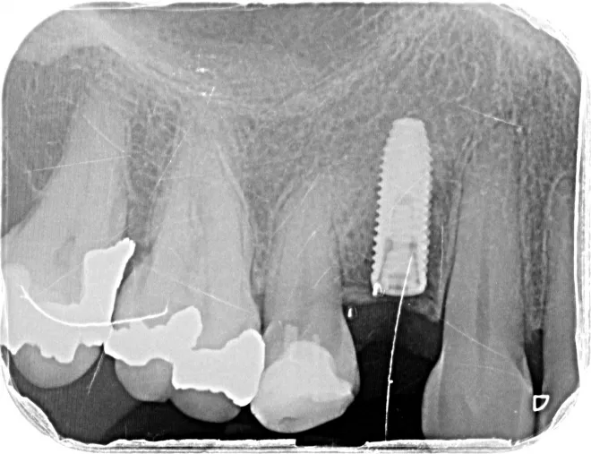 Les implants et prothèses dentaires réalisées par un spécialiste en parodontologie