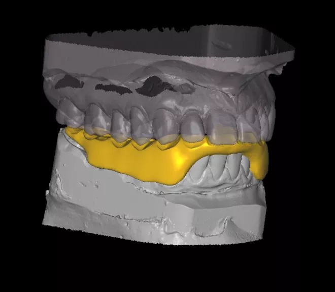 Nous vous partageons par après nos conclusions avec vous en nous appuyant sur la radiographie et les tests préopératoires. Nous répondrons à toutes vos interrogations et planifierons le traitement à réaliser